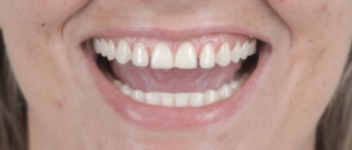 Antes